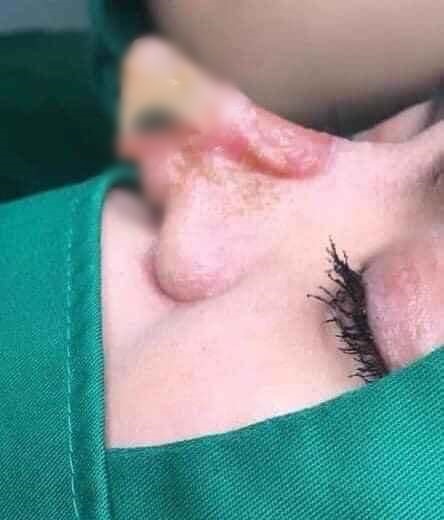 Hàng loạt biến chứng