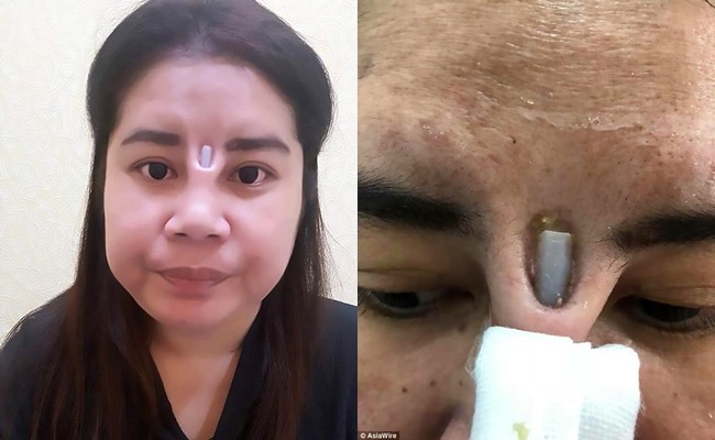 Hàng loạt biến chứng