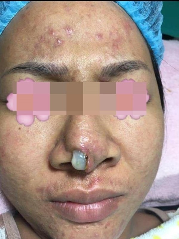 Hàng loạt biến chứng