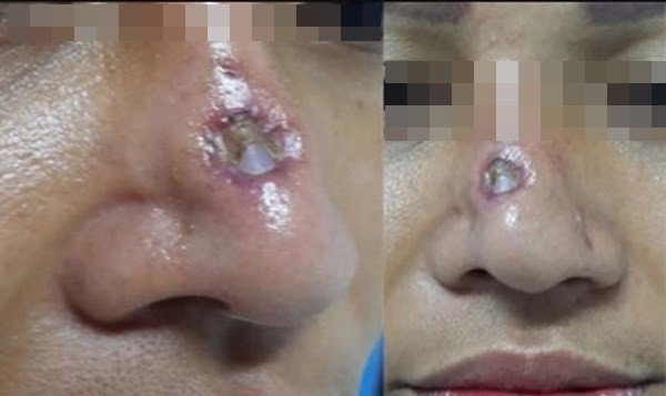 Hàng loạt biến chứng