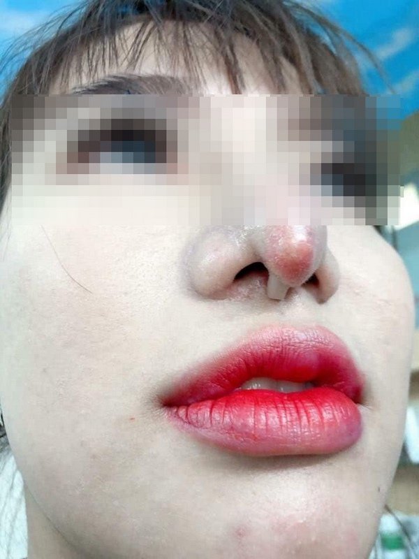 Hàng loạt biến chứng