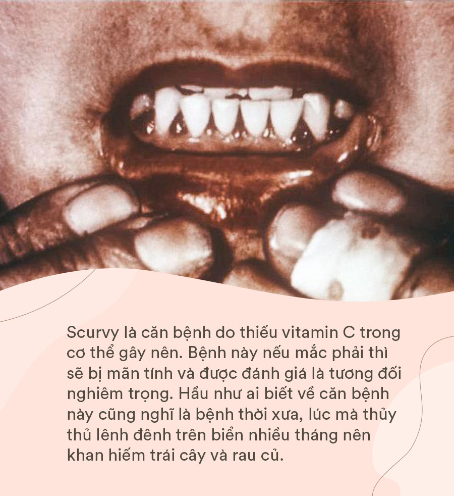 Sự thật bí ẩn phía sau “lời nguyền” đã giết chết hàng triệu thủy thủ và đoàn thám hiểm ngày xưa, giờ mới được khoa học hé lộ bằng y học - Ảnh 5. Sự thật bí ẩn phía sau “lời nguyền” đã giết chết hàng triệu thủy thủ và đoàn thám hiểm ngày xưa, giờ mới được khoa học hé lộ bằng y học - Ảnh 5.
