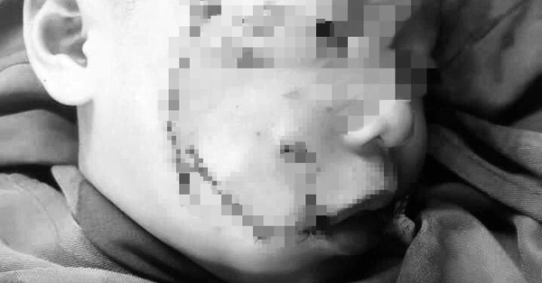 Cháu bé 3 tuổi bị chó nhà cắn nát vùng mặt ở Nghệ An