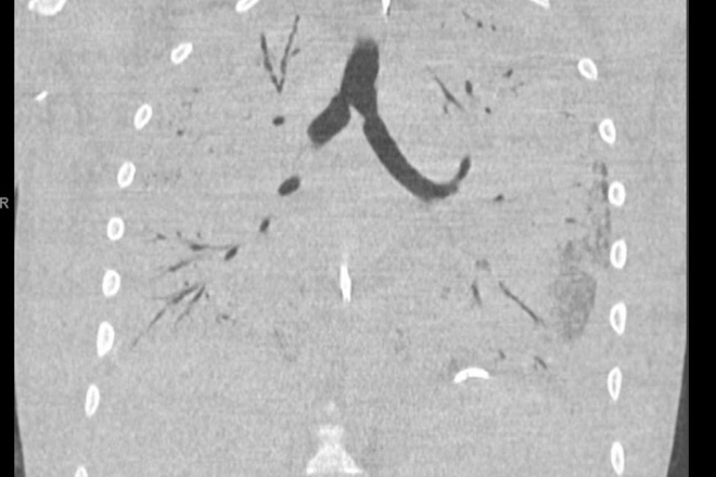 Ruỗng phổi vì hút thuốc lá điện tử, thiếu niên 17 tuổi phải ghép cả hai lá phổi mới - Ảnh 3.