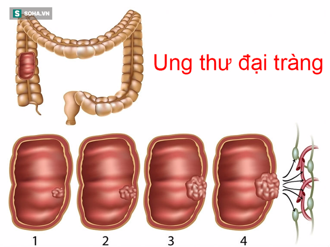 Bí ẩn: Tỷ lệ ung thư đại trực tràng của thế hệ 9x đã tăng gấp 2-4 lần thế hệ ông bà - Ảnh 5.