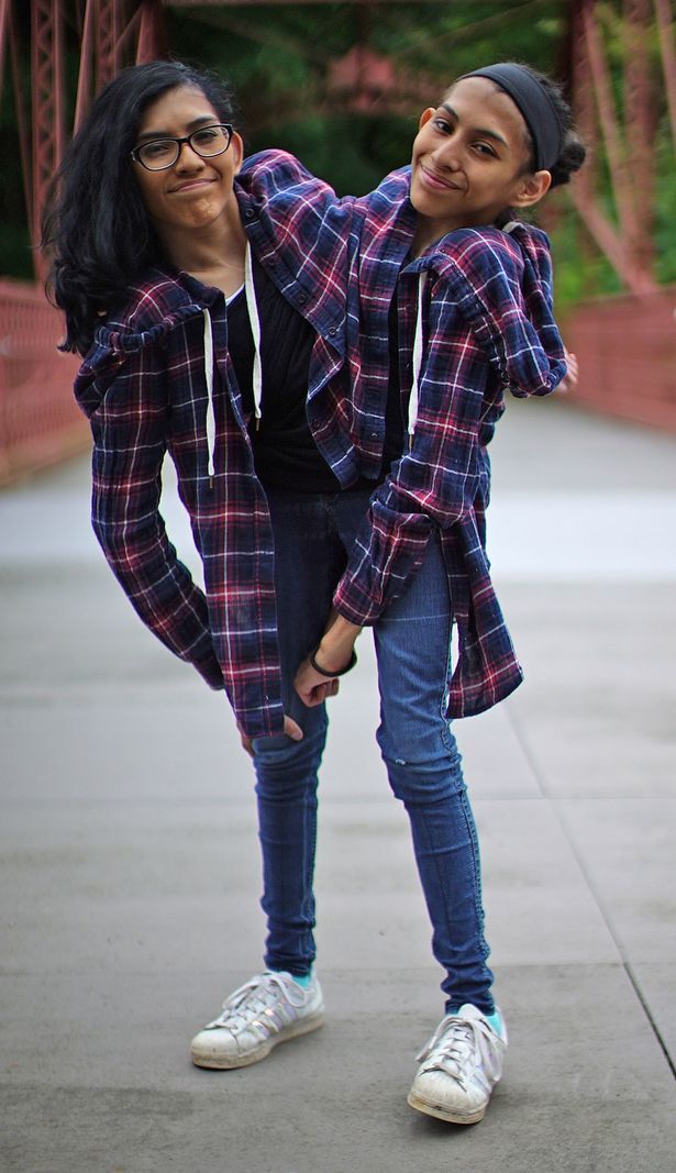 Cuộc sống phi thường của hai cô gái song sinh dính liền 19 tuổi - 3