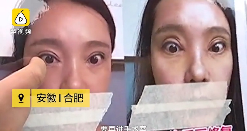 Thê thảm cô gái không thể nhắm mắt sau khi phẫu thuật cắt mí - 1