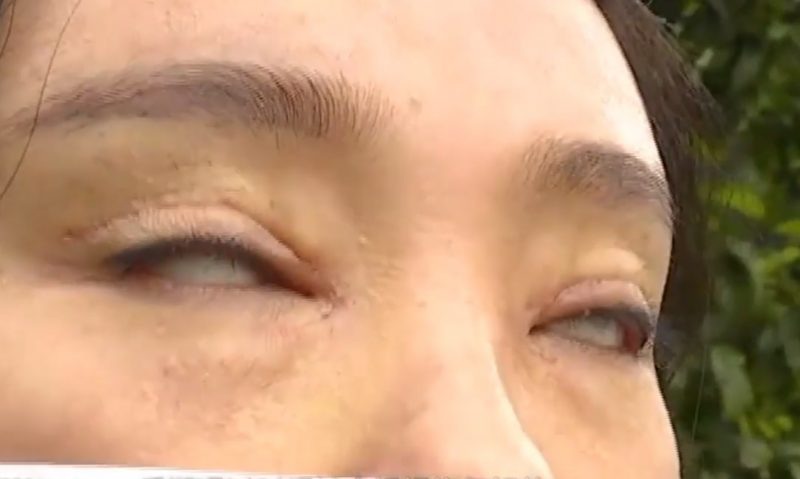 Thê thảm cô gái không thể nhắm mắt sau khi phẫu thuật cắt mí - 2