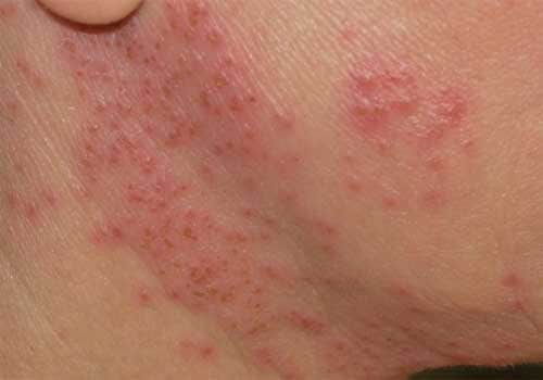 Cảnh báo: Kem trộn núp bóng mỹ phẩm thiên nhiên và những hiểm họa khôn lường - 8