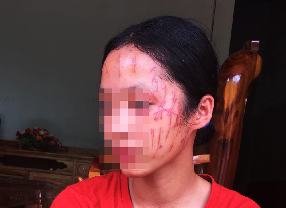 Nữ sinh lớp 8 bị đàn chị cào nát mặt - 1
