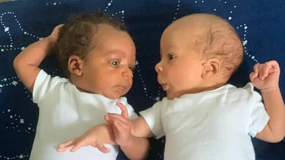 Kỳ lạ cặp sinh đôi một da đen, một da trắng - 1