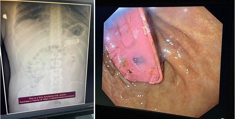 Hy hữu người đàn ông nuốt cả chiếc điện thoại di động vào bụng - 1