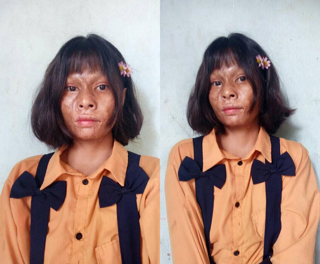 Cuộc đời buồn của cô gái có khuôn mặt bị gọi là 'khỉ đột' ở Gia Lai
