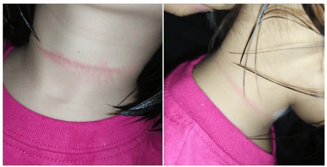 Vết hằn trên cổ một bé gái 4 tuổi người Philippines vì thực hiện theo thử thách 