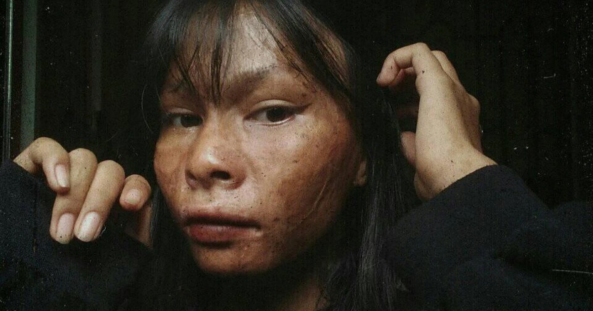 Cuộc đời buồn của cô gái có khuôn mặt bị gọi là 'khỉ đột' ở Gia Lai