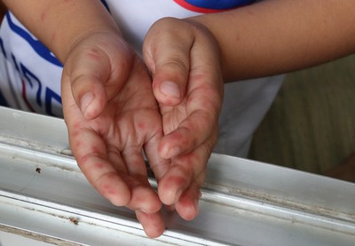 Cases of hand-foot-mouth disease rise sharply in HCM City