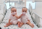 Loving photos show conjoined twins after removal of leg cast