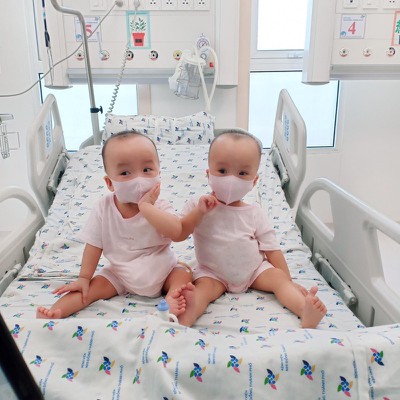 Loving photos show conjoined twins after removal of leg cast