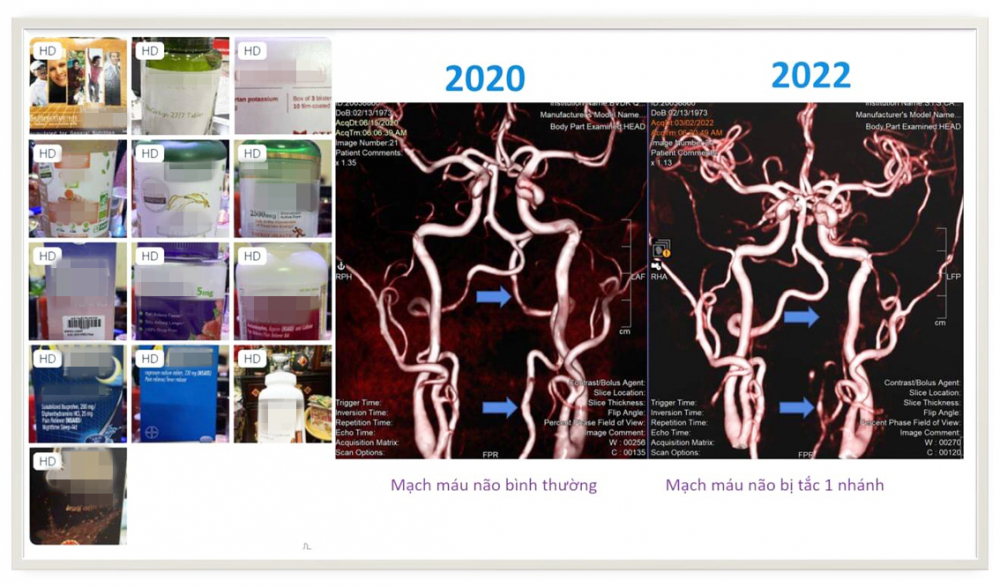 Bác sĩ Trần Chí Cường phát hiện một trường hợp bệnh nặng nghi dùng nhiều loại thực phẩm chức năng như hình trên