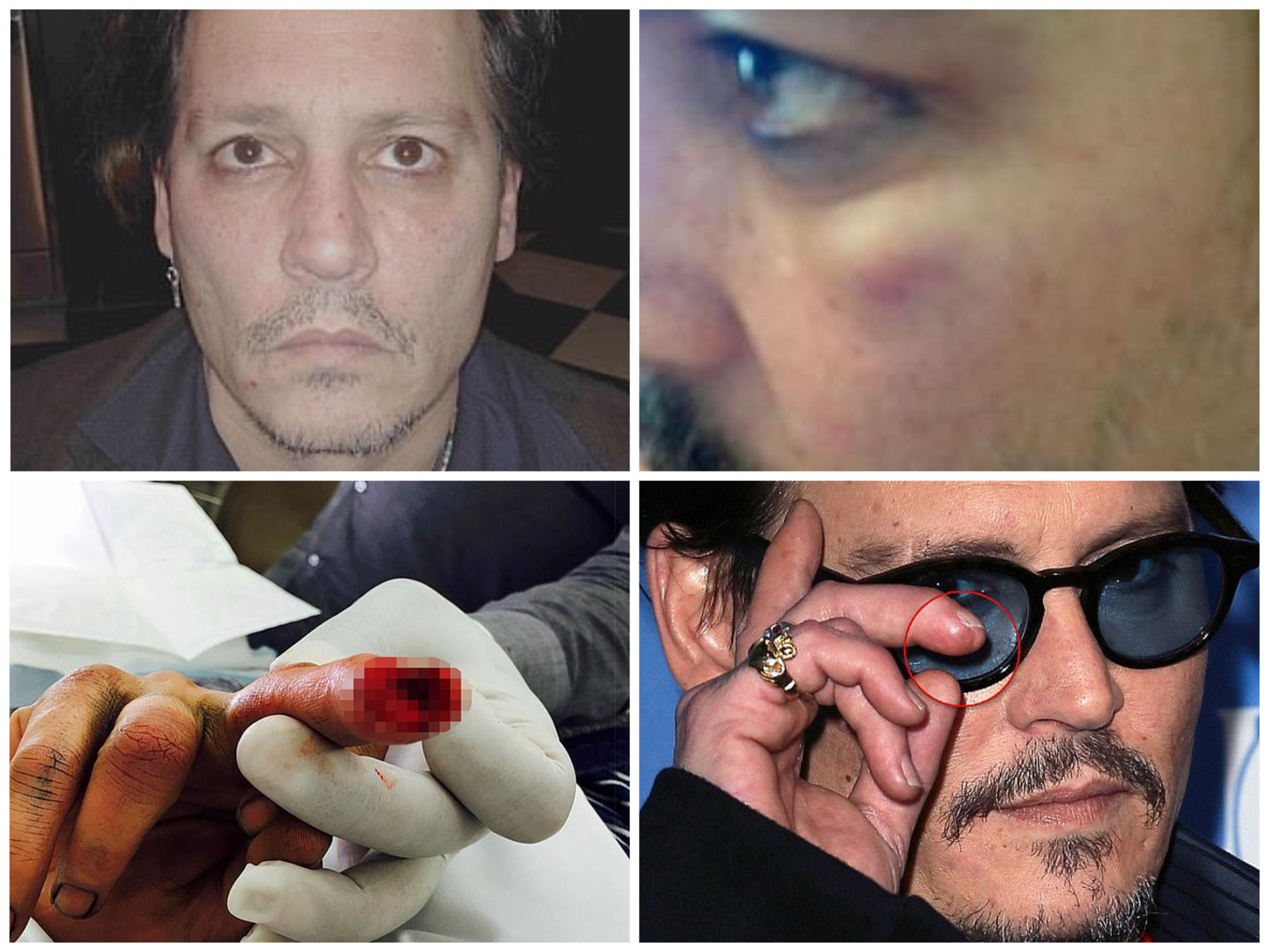 Johnny Depp và hình ảnh vết thương mà anh bị vợ cũ bạo hành