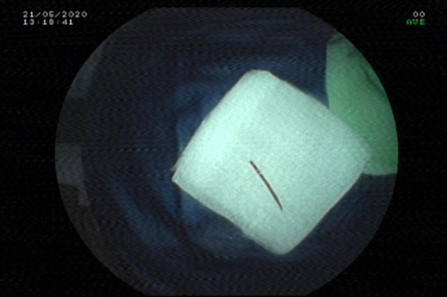 Doctors remove toothpick from female patient's anus