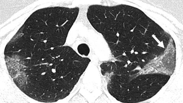 Không chỉ ‘thích’ phổi, virus corona mới còn tấn công hàng loạt nội tạng