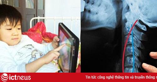 Trẻ 7 tuổi bị thoái hóa đốt sống cổ vì iPad