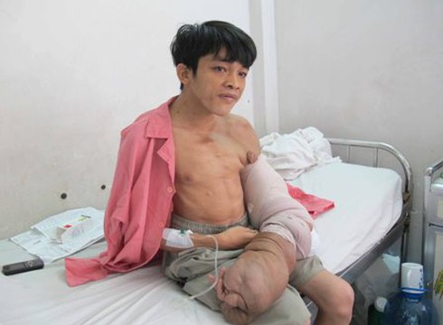 Bóc tách khối u 10kg của chàng trai bán vé số - ảnh 1