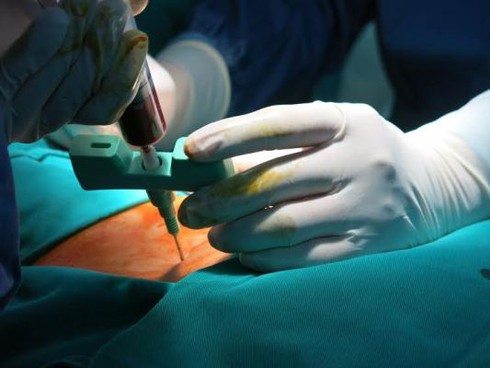 Chữa rối loạn đại tiểu tiện do thoát vị màng não tủy bằng tế bào gốc - ảnh 2