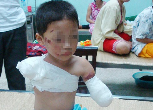 Cháu bé bị động vật cắn đứt lìa 2 tay ở Phú Thọ - ảnh 1