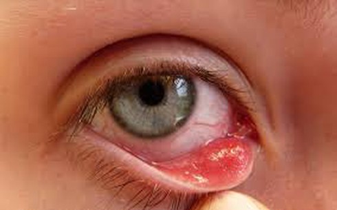 Cách chữa bệnh đau mắt đỏ nhanh khỏi nhất - ảnh 1