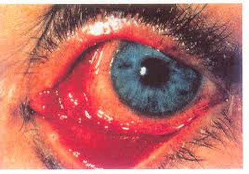 Bệnh đau mắt đỏ ở trẻ em và cách điều trị hiệu quả - ảnh 1