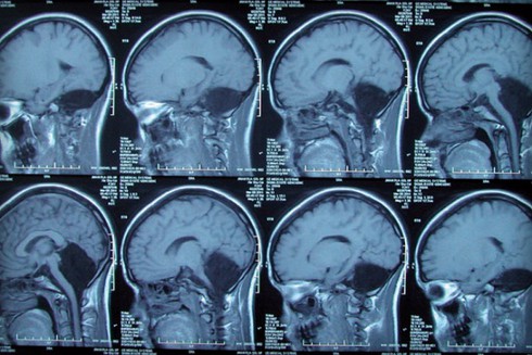 Cô gái trẻ sinh ra đã không có tiểu não - ảnh 1