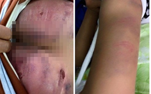 Con gái 14 tuổi rạn xương tay vì bố lấy cán chổi lau nhà...