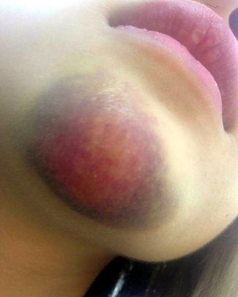 Phụ xe buýt hành hung nữ sinh thâm tím cằm sẽ bị sa thải - ảnh 2