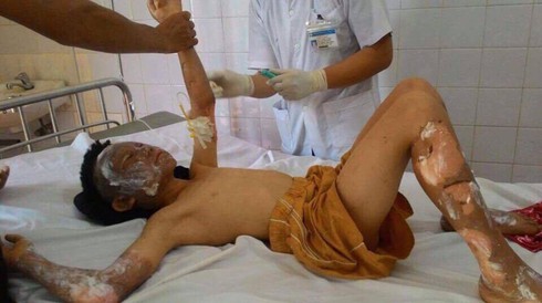 Bật bếp gas ăn lẩu, 10 người trong gia đình bị bỏng - ảnh 1