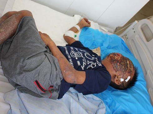 Nam sinh 14 tuổi ngã vào bếp củi, bỏng nặng - ảnh 1