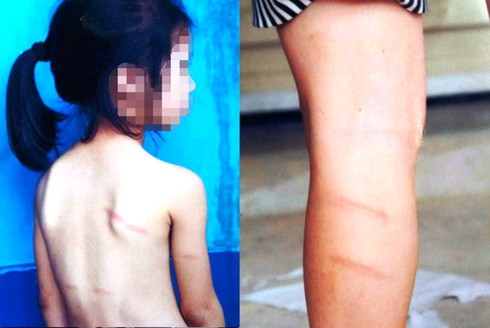 Nghệ An: Cô giáo đánh học sinh thâm tím lưng và chân vì không làm được bài - ảnh 2