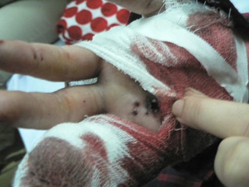 Hải Phòng: Mở giúp bưu phẩm, nữ kế toán bị “bom thư” phát nổ - ảnh 1