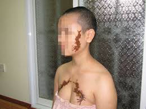 Chủ quán xăm rết lên mặt nhân viên đi tù - ảnh 1