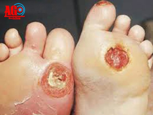 Đái tháo đường và những biến chứng nguy hiểm - ảnh 1