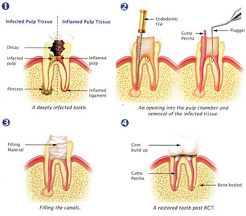 Răng bị diệt tủy có dễ tổn thương? - ảnh 1