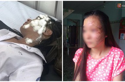 Ghen tuông, chồng hắt axit vào mặt vợ - ảnh 1