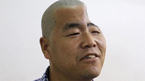 Những 'quái nhân' đầu lõm, móp, mất một nửa