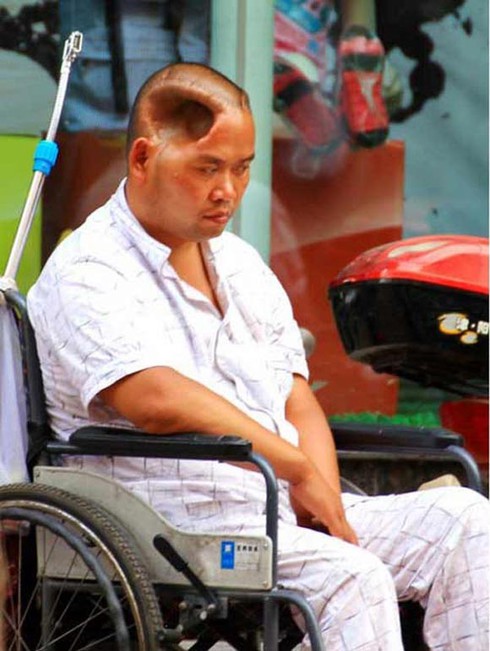 Những 'quái nhân' đầu lõm, móp, mất một nửa