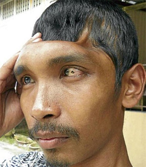 Những 'quái nhân' đầu lõm, móp, mất một nửa