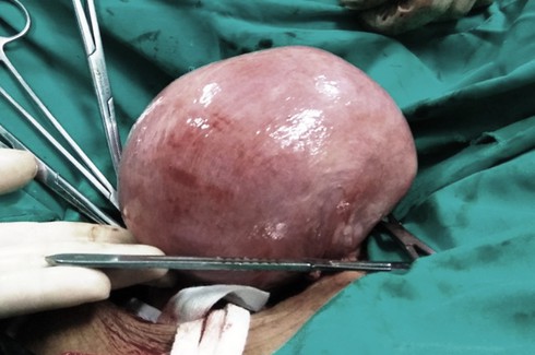 Nghệ An: Cắt bỏ khối u nặng 2,5kg từ tử cung một phụ nữ bị dị tật - ảnh 1