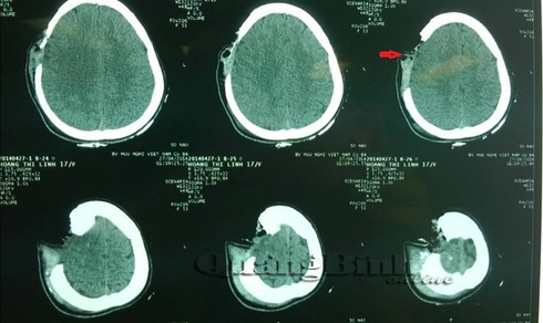 Quảng Bình: Cứu sống thiếu nữ vỡ văng mảng lớn xương sọ - ảnh 1