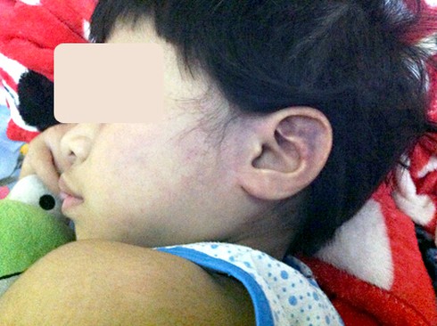 Bé gái bị đánh bầm tím mặt tại trường mầm non - ảnh 1