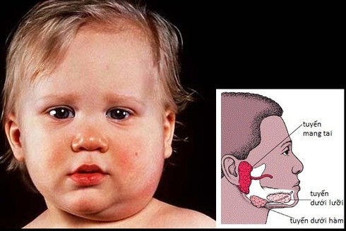 Phân biệt bệnh quai bị và viêm tuyến nước bọt - ảnh 1